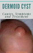 Image result for Dermoid Cyst Symptoms
