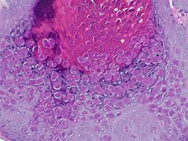 Image result for Immunoflourescence Molluscum