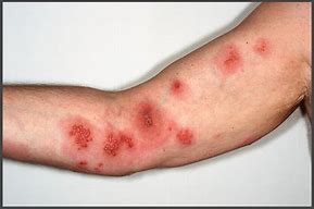 Image result for Shingles On Forearm