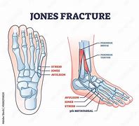 Image result for Jones Fracture Scar