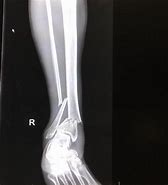 Image result for Broken Leg X-ray Meme