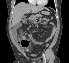 Image result for Portal Venous Gas CT
