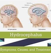 Image result for Hydrocephalus Diagnosis