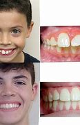 Image result for Treatment of Long Front Teeth with Braces Before and After