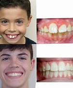 Image result for Protruding Teeth Before and After Braces