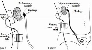 Image result for Nephroureteral Stent Placement