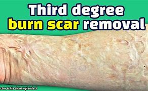 Image result for What Do 3rd Degree Burns Look Like