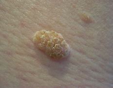 Image result for White Crusty Moles On Skin