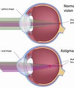 Image result for Astigmatism Eye Look Like