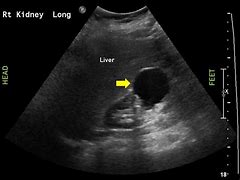 Image result for Simple Renal Cyst Ultrasound