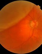 Image result for Retinal Detachment Fundus