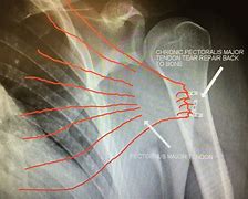Image result for PEC Muscle Tear
