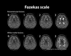 Image result for Fazekas Scale