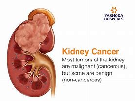 Image result for 2 Cm Kidney Tumor