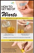 Image result for Hand Wart Removal