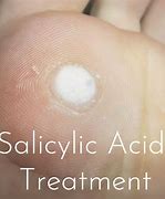 Image result for Wart After Salicylic Acid Treatment