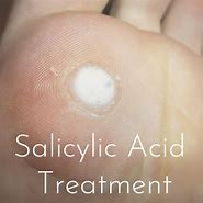 Image result for Plantar Wart Treatment Salicylic Acid
