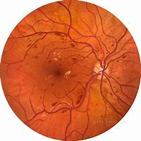Image result for Npdr Fundus Drawing Picture