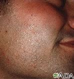 Image result for Molluscum Contagiosum Rash On Face