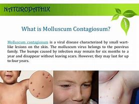Image result for Molluscum Contagiosum Treatment in Pediatrics Medication