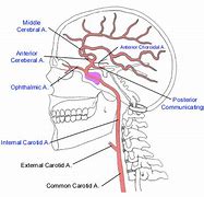 Image result for Posterior Internal Carotid Artery
