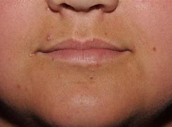 Image result for Molluscum On Face