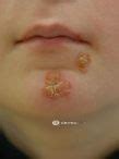 Image result for Impetigo Contagiosum