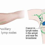 Image result for Axillary Lymph Nodes On Mammogram