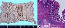 Image result for Tumor Sizes in Centimeters