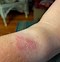 Image result for Wrist Watch Skin Marks