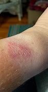 Image result for Apple Watch Burning Wrist