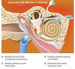 Image result for Inner Ear Disease