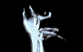 Image result for Exploded Hand