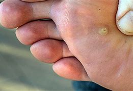 Image result for What Causes Plantar Warts
