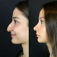 Image result for Rhinoplasty Nose Surgery