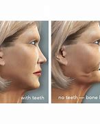 Image result for Before and After Jaw Bone Loss