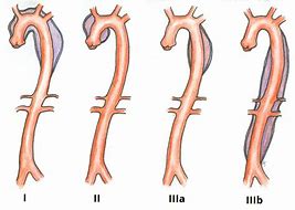 Image result for Aortic Dissection Types