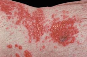 Image result for Shingles On Forearm