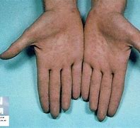 Image result for Syphilis Hands
