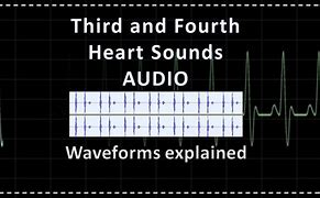 Image result for Heart Souns Gallop