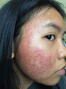 Image result for Allergic Reaction Facial Rash