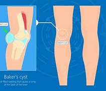 Image result for Common Wart On Knee