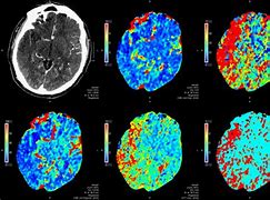 Image result for Brain CT Scan Head