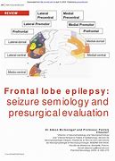 Image result for Bonini Classification of Frontal Lobe Epilepsy