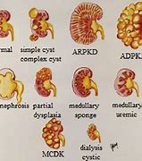 Image result for Kidney Stone versus Complex Cyst