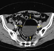 Image result for Ovarian Dermoid Picture On US