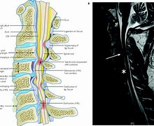 Image result for myelopathy