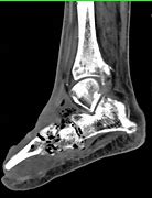 Image result for Gas Leg CT