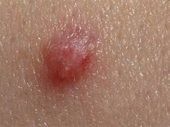 Image result for First Signs of Genital Warts