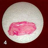 Image result for Ear Lobe Papilloma